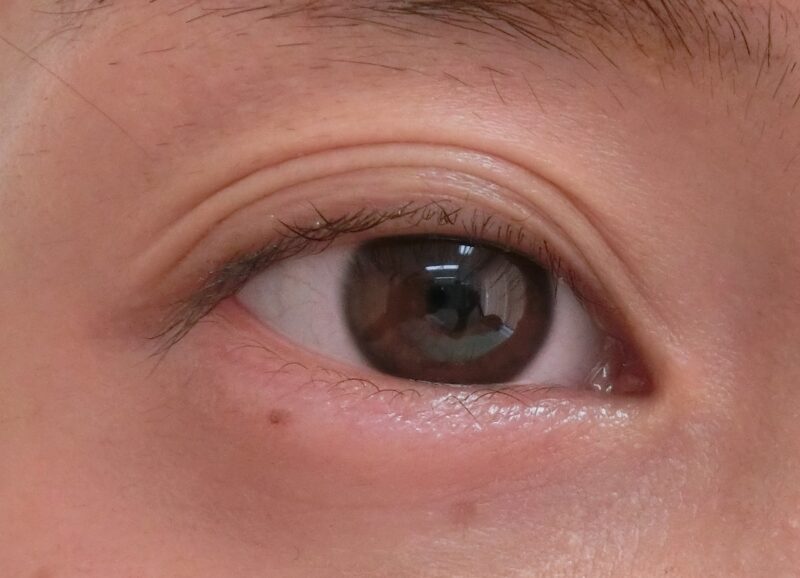 三重まぶたの例（表参道美容外科クリニックHPより引用）の画像