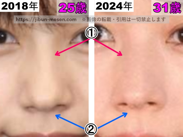 有村架純の鼻の整形検証2018年〜2024年（拡大）の画像