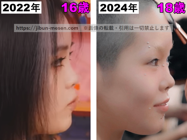 XGココナの口の整形検証2022年〜2024年（横顔）の画像