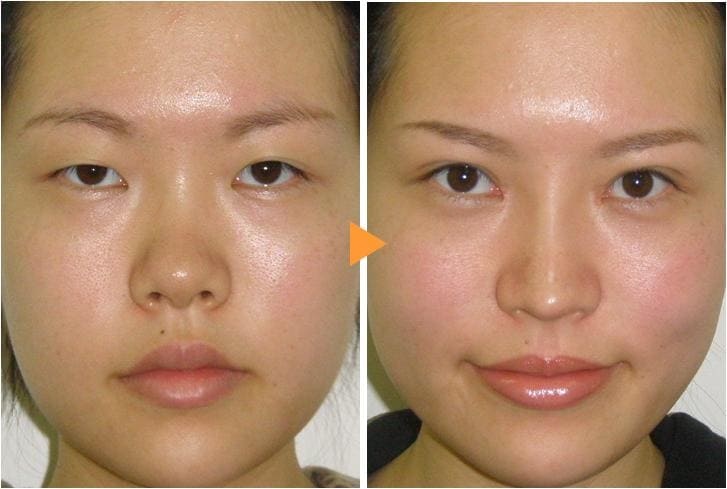 鼻中隔延長による鼻の整形例（銀座みゆき通り美容外科大阪院HPより引用）の画像