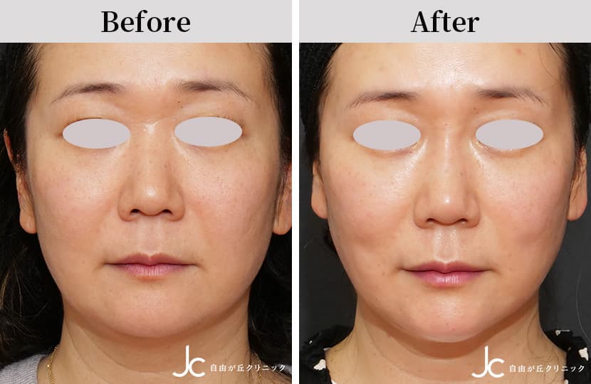 ヒアルロン酸注射による頬の整形例（自由が丘クリニックHPより引用）_1の画像