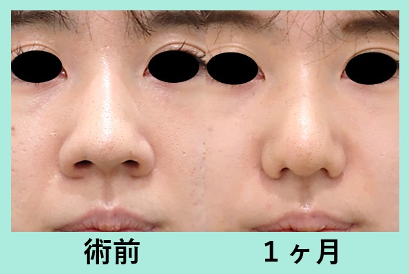 小鼻縮小術による鼻の整形例（WOMクリニック銀座HPより引用）の画像