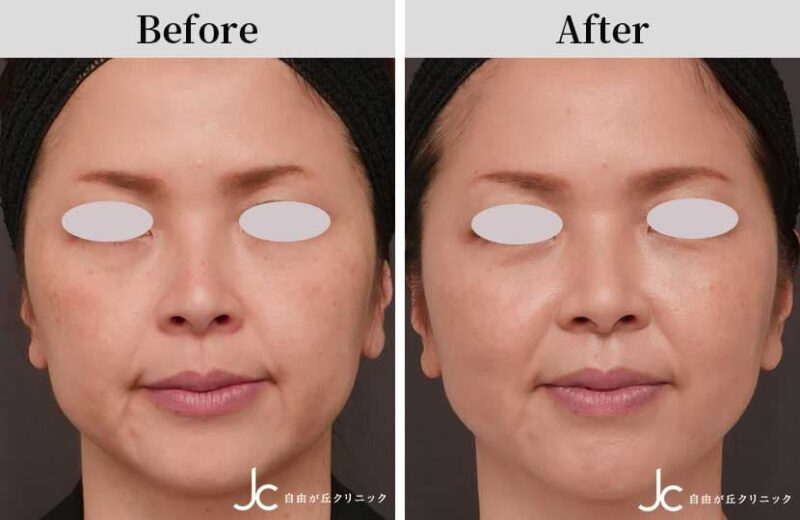 糸リフトによる頬の整形例（自由が丘クリニック-症例写真より引用）_2の画像