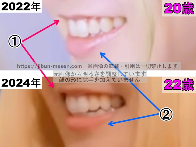 XGヒナタの唇の整形検証2022年〜2024年（横顔・拡大）の画像