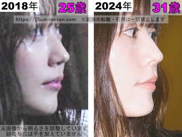 有村架純の唇の整形検証2018年〜2024年（横顔）