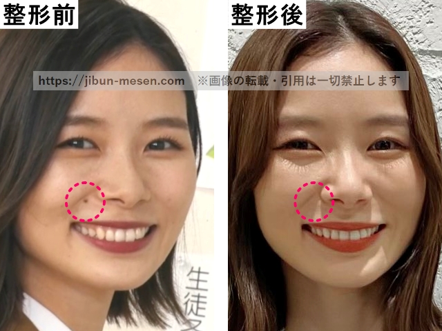 朝日奈央のホクロの整形のビフォーアフターの画像