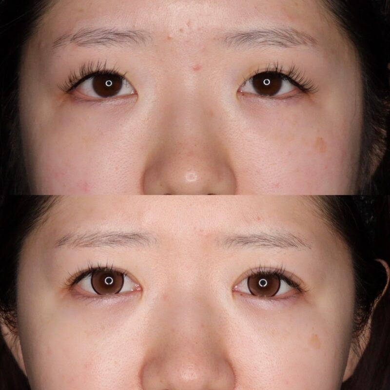 目頭切開による目の整形例（セレクトクリニックHPより引用）の画像