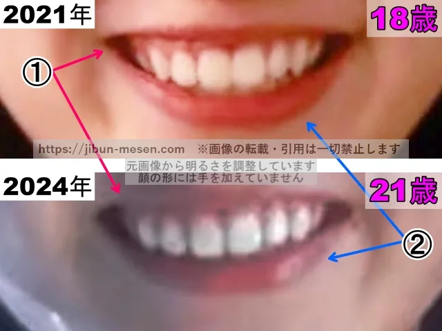 飯沼愛の唇の整形検証2021年～2024年（拡大）