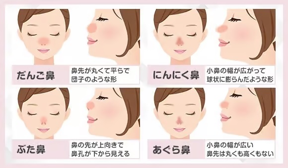 だんご鼻：鼻先が丸くて平らで団子のような形 にんにく鼻：小鼻の幅が広がって球状に膨らんだような形 ぶた鼻：鼻の先が上向きで鼻孔が下から見える あぐら鼻：小鼻の幅が広い。鼻先は丸くも高くもない