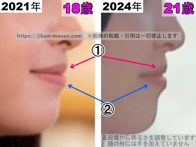 飯沼愛の唇の整形検証2021年～2024年（横顔・拡大）の画像