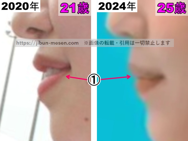 横田真悠の唇の整形検証2020年～2024年（横顔・拡大）の画像