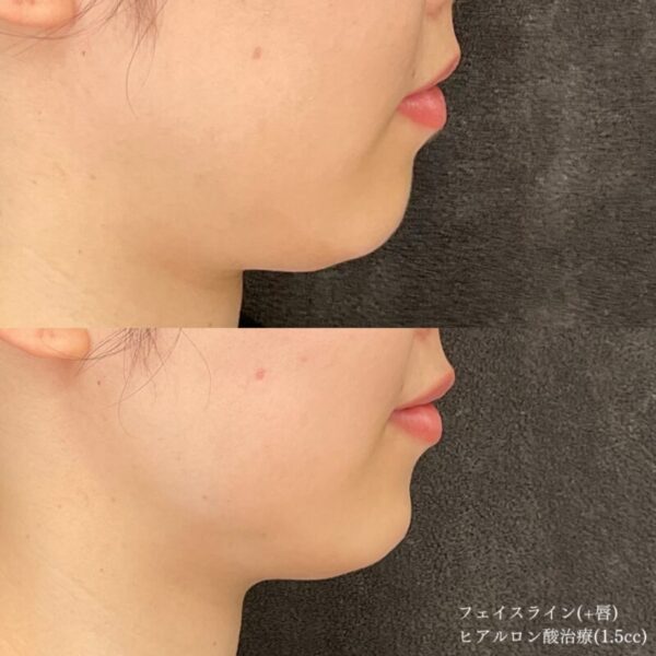 ヒアルロン酸注射による唇の整形例（JスキンクリニックHPより引用）の画像