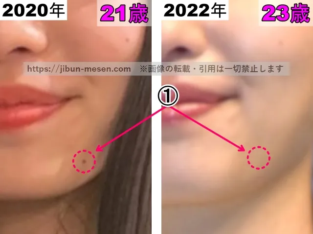 横田真悠のホクロの整形検証2020年~2022年(拡大)