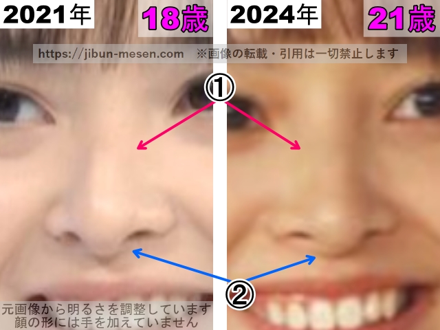 飯沼愛の鼻の整形検証2021年～2024年（拡大）の画像