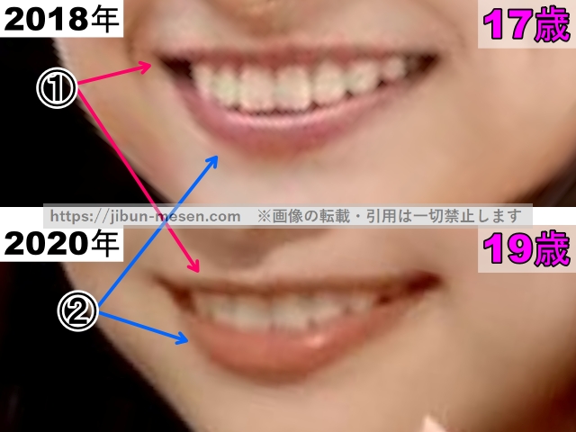 影山優佳の唇の整形検証2018年～2020年（拡大）の画像