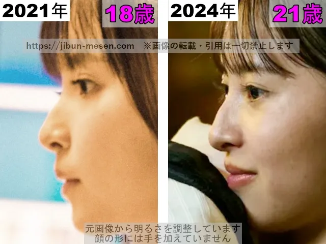 飯沼愛の鼻の整形検証2021年～2024年（横顔）