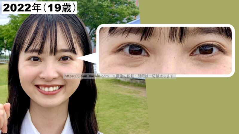 飯沼愛の二重幅の左右差の画像