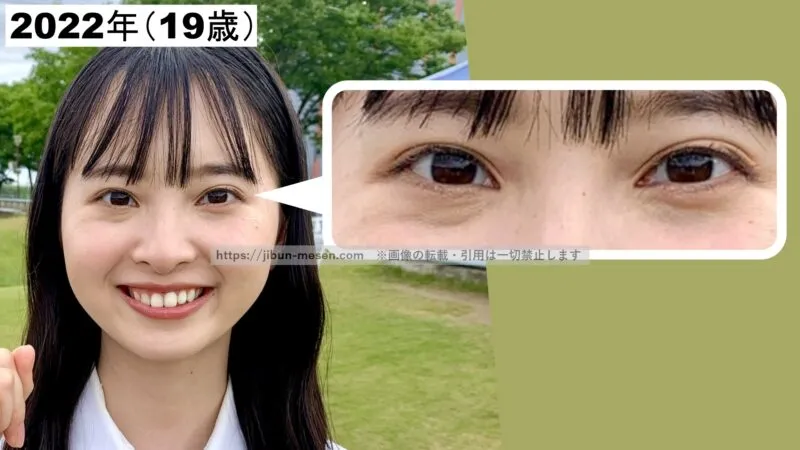 飯沼愛の二重幅の左右差