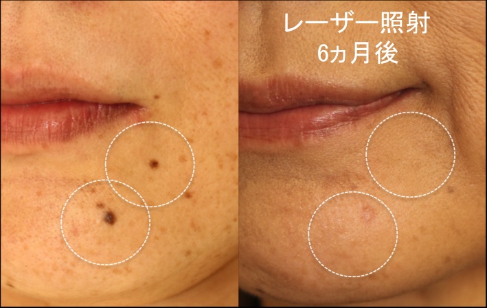 レーザー治療によるホクロの整形例（YUKI皮フ科形成外科HPより引用）の画像