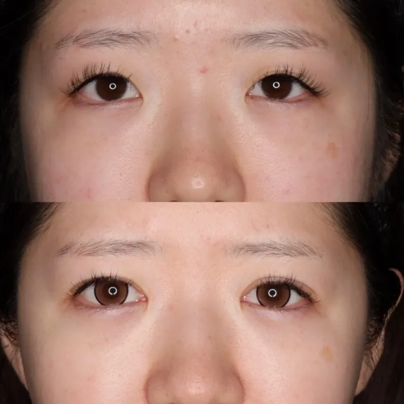 目頭切開による目の整形例（セレクトクリニックHPより引用）