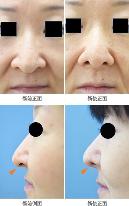 鼻柱挙上術による鼻の整形例（みずほクリニックHPより引用）の画像
