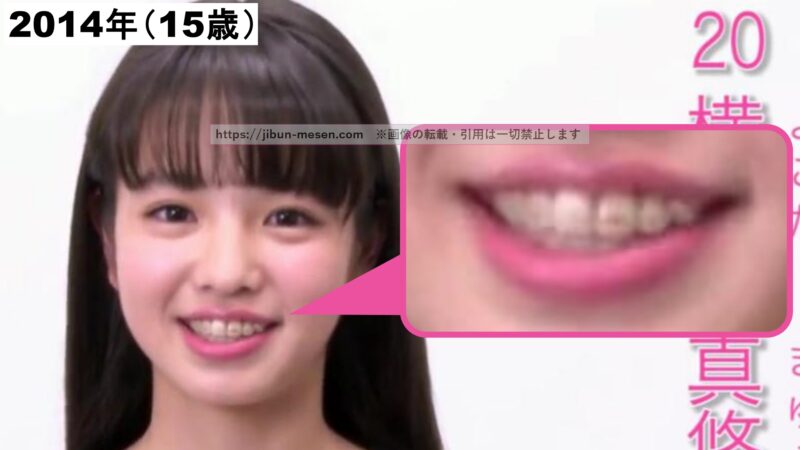 歯に矯正器具を付けている横田真悠の画像