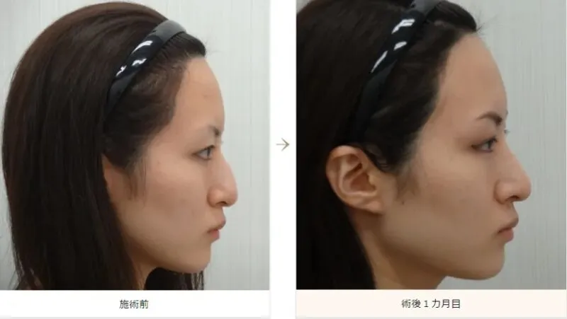 わし鼻修正による鼻の整形例（水の森美容クリニックHPより引用）