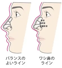 鼻骨の出っ張り（銀座みゆき通り美容外科HPより引用）