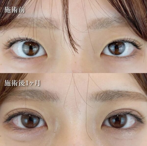二重切開法による目の整形例（東京中央美容外科HPより引用）の画像