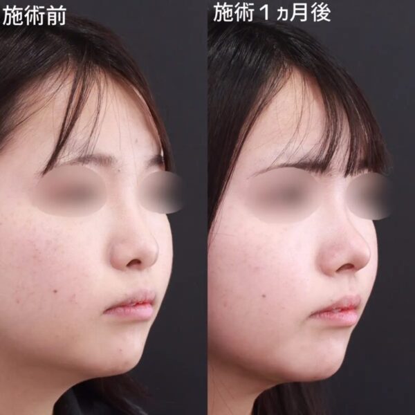 鼻尖形成術による鼻の整形例（TAクリニックグループHPより引用）の画像
