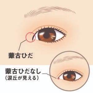 蒙古ひだの例（ヴィーナスビューティークリニックHPより引用）