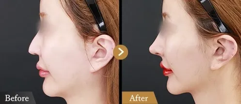 鼻中隔延長による鼻の整形例(TAクリニックグループHPより引用)