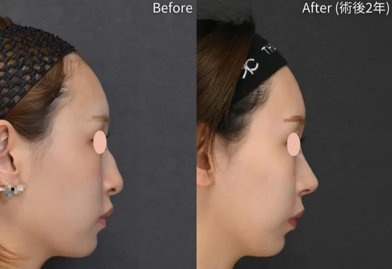 鼻尖形成術による鼻の整形例(ザロッポンギクリニックHPより引用)