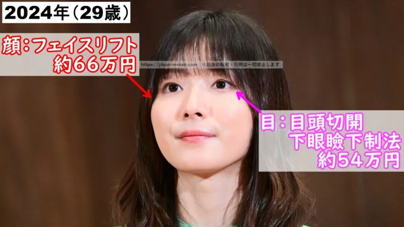 松岡茉優が整形した箇所とその費用