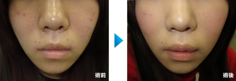 口唇拡大術による唇の整形例(三輪皮フ科形成外科HPより引用)