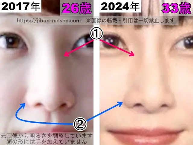 松井玲奈の鼻の整形検証2017年～2024年（拡大）