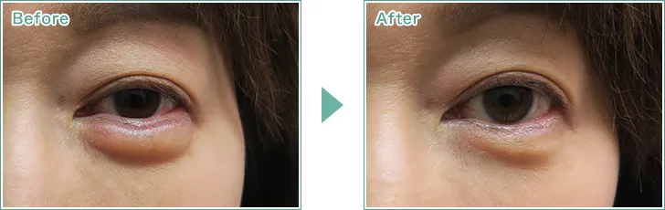 ヒアルロン酸分解・溶解の症例写真（光伸メディカルクリニックHPより引用）