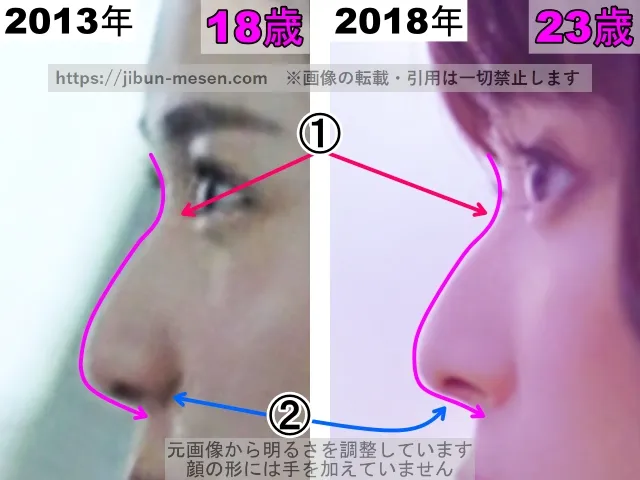 松岡茉優の鼻の整形検証2013年〜2018年(横顔・拡大)
