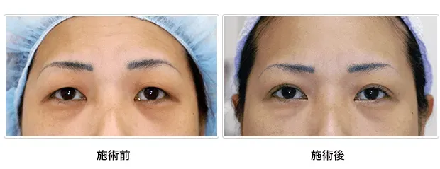 挙筋前転法による目の整形例（立花クリニックHPより引用）