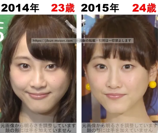 松井玲奈の整形検証2014年~2015年