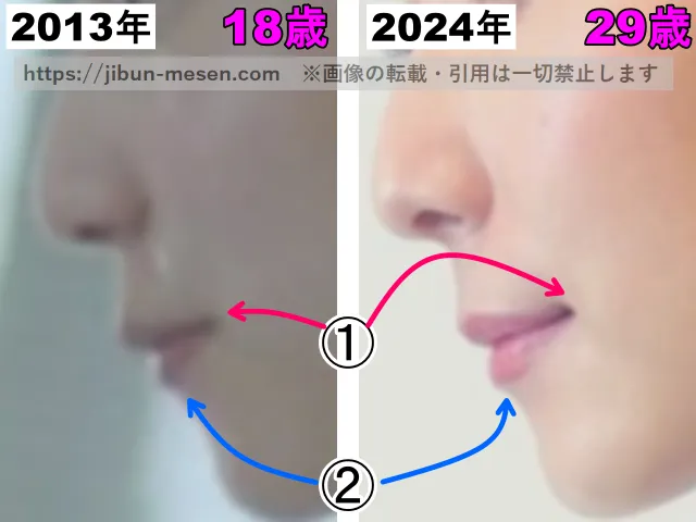 松岡茉優の口の整形検証2013年〜2024年(横顔・拡大)