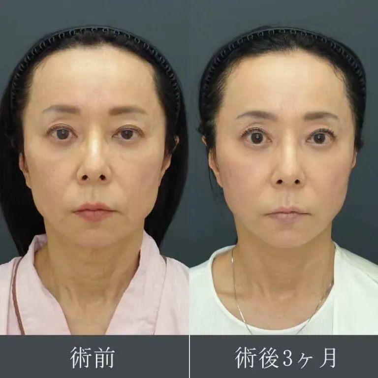 フェイスリフトによる顔の整形例（水の森美容クリニックHPより引用）