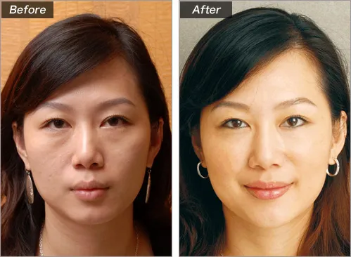 ヒアルロン酸注射による頬の整形例（城本クリニックHPより引用）