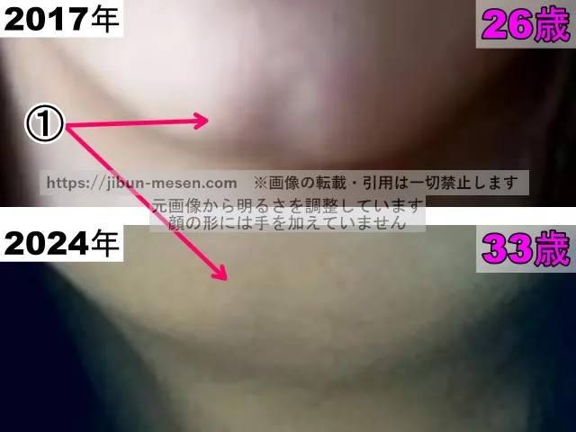 松井玲奈の顎の整形検証2017年～2024年（拡大）