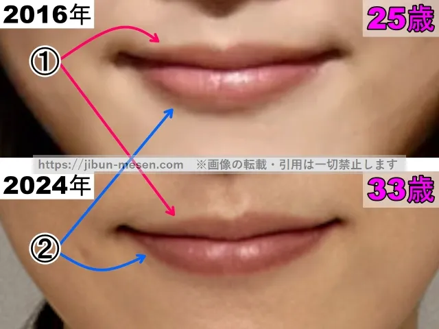 松井玲奈の唇の整形検証2016年～2024年（拡大）