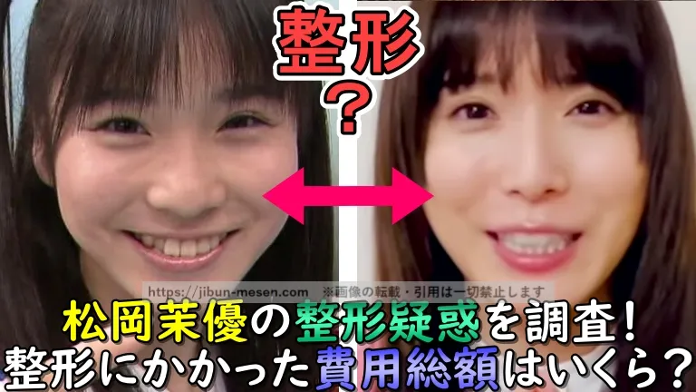 整形？松岡茉優の整形疑惑を調査！整形にかかった費用はいくら？