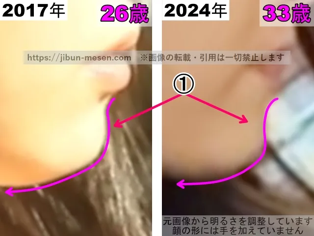 松井玲奈の顎の整形検証2017年～2024年（横顔・拡大）