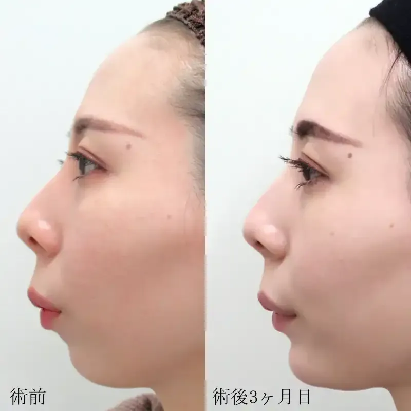 顎プロテーゼによる顎の整形例（水の森美容クリニックHPより引用）