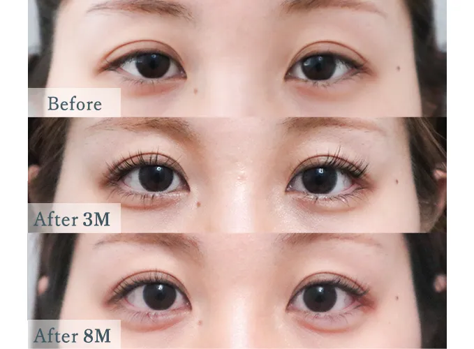 下眼瞼下制法による目の整形例（ザ・プラス美容外科HPより引用）