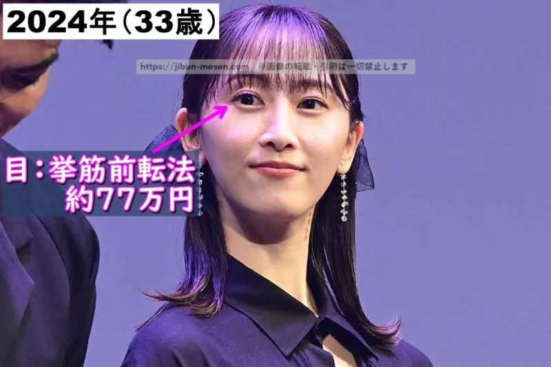 松井玲奈が整形した箇所とその費用